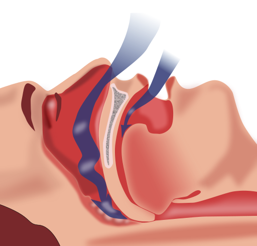 Sleep Apnea Treatment